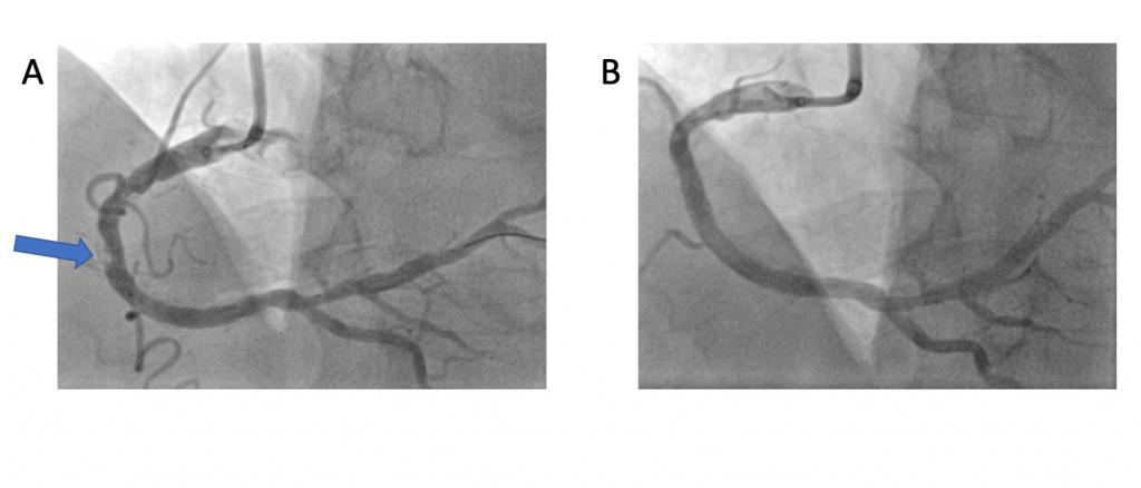 Koronarangiographie: Stark kalzifizierte Engstelle der rechten Herzkranzarterie vor (A) und nach (B) koronarer Lithoplastie