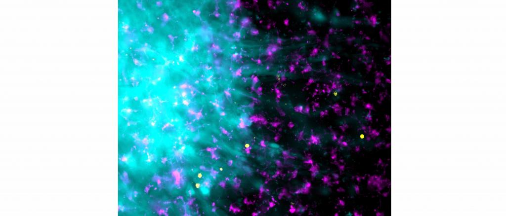 Image: Caption: T cells (yellow)-Microglia (magenta)-Tumor (cyan) crosstalk in a human neocortical slice model